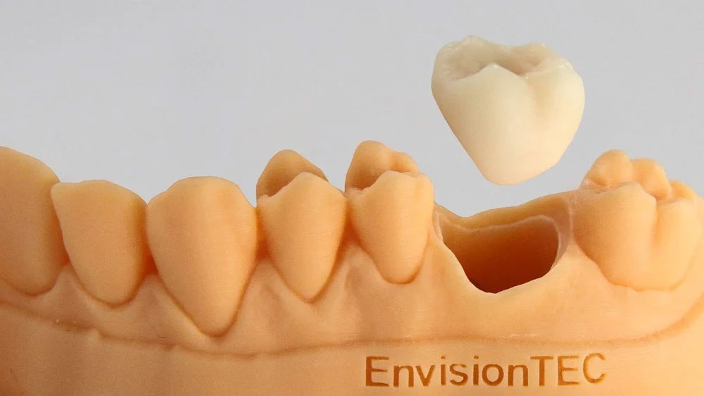 پرینت سه بعدی تاج دندان - سه بعدی دندان