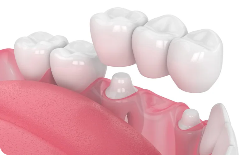 کاربرد اسکن سه‌بعدی بریج و روکش دندان 3d-scanner-application-dental-crowns-and-bridges