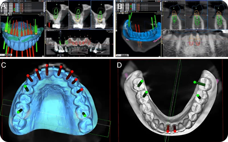 کاربرد اسکن سه‌بعدی برای سریکال گاید دندان پزشکی ایمپلنت 3d-scanner-application-dental-surgical-guide